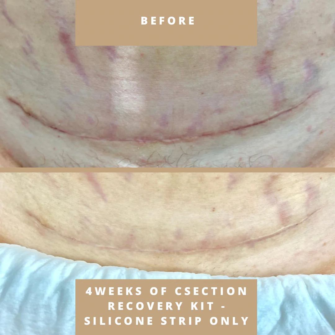 Csection Scar Recovery Kit