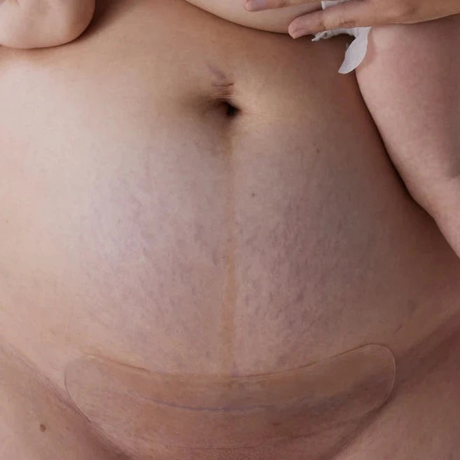 Bare Mum - Silicone Gel Scar Strips